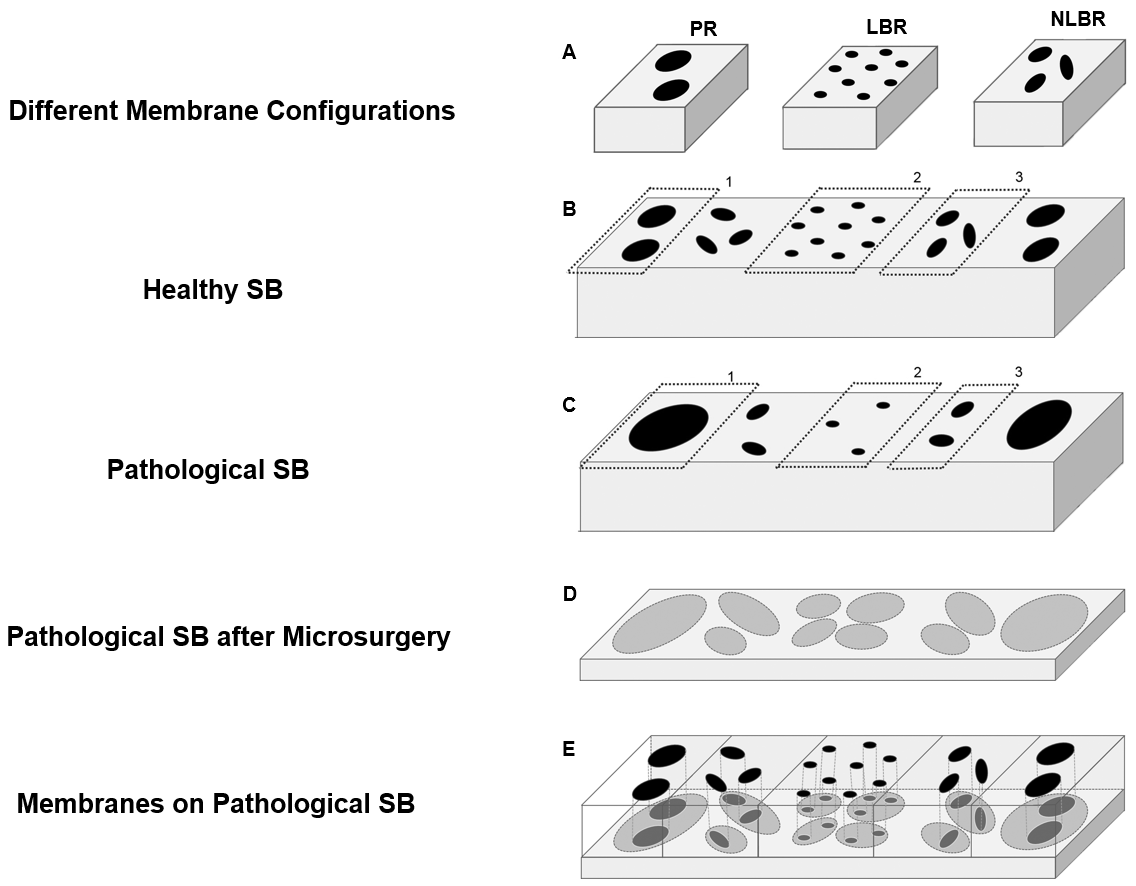 Figure 2 shows a scheme for implantation of preferred embodiments of membranes in different areas (peripheral rim (PR, 1), load bearing region (LBR, 2), non-load bearing region (NLBR, 3)) of a knee joint. A) Membranes with different channel structures corresponding to the respective SB areas are available. B) In healthy subchondral bone, channel configuration differs in the different areas of the joint (see also Fig. 1). C) Pathological channel configurations differ from that present in healthy bone (as shown B). D) shows a layer of pathological SB. Removal of pathological SB reveals underlying SB structures with increased number and cross-sectional area of microchannels. E) Corresponding membranes are fixed on the microsurgically pretreated SB to reinstate a physiologic size/number of channels (reflecting healthy SB microarchitecture). Source: US16/282,444.